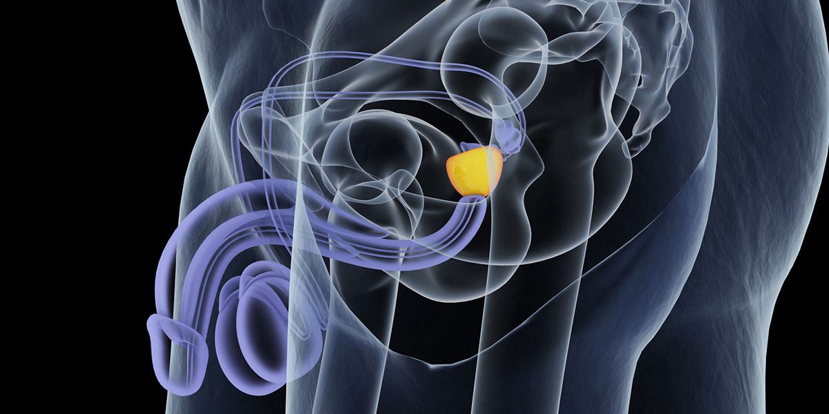 tumore alla prostata con chemioterapia